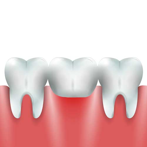 dental bridges t dundas west dentistry in Etobicoke
